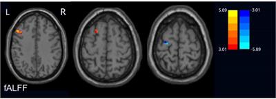 Frontiers  Neural activity in adults with major depressive disorder  differs from that in healthy individuals: A resting-state functional  magnetic resonance imaging study