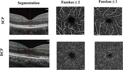 Frontiers Structural And Microvascular Changes In The Macular Are Associated With Severity Of White Matter Lesions Neurology