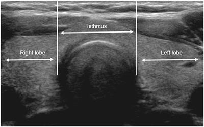 Frontiers | Comparison of Ultrasonography Features and K-TIRADS for Isthmic  and Lobar Papillary Thyroid Carcinomas: A Single-Center Study
