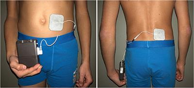 Frontiers | A Pilot Study of Non-invasive Sacral Nerve Stimulation in Treatment of Constipation in Childhood and Adolescence | Pediatrics