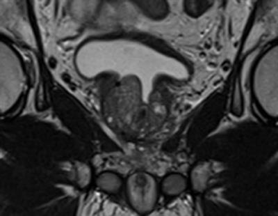 mri prostate after turp)