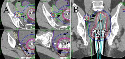Frontiers | CT-Guided Pelvic Lymph Nodal Brachytherapy