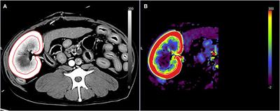 Frontiers | Comparison of Renal Blood Flow Using Maximum Slope-Based Computed Tomography ...