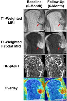Frontiers Multi Modal Imaging To Assess The Interaction Between Inflammation And Bone Damage Progression In Inflammatory Arthritis Medicine