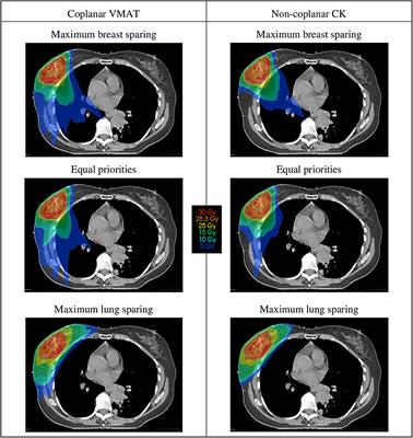 Frontiers  Reducing the Risk of Secondary Lung Cancer in Treatment  Planning of Accelerated Partial Breast Irradiation