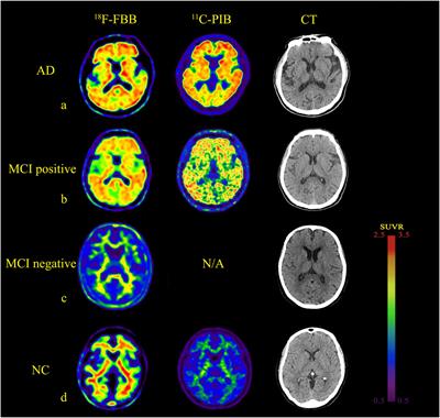 Frontiers | 18F-Florbetaben Amyloid PET Imaging: A Chinese Study in ...