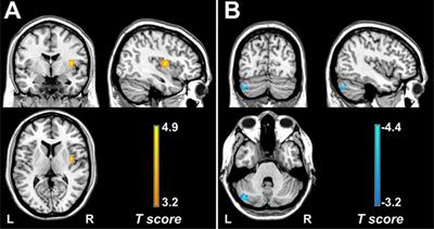 Frontiers Functional Alterations In The Posterior Insula And Cerebellum In Migraine Without Aura A Resting State Mri Study Behavioral Neuroscience Frontiers Functional Alterations In The Posterior Insula And Cerebellum In Migraine Without Aura A Resting State Mri Study Behavioral Neuroscience