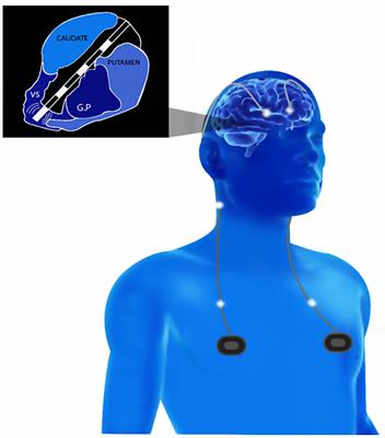 Frontiers | Sustained Recovery in a Treatment-Refractory Obsessive–Compulsive Disorder Patient After Deep Brain Stimulation Battery Failure Frontiers | Sustained Recovery in a Treatment-Refractory Obsessive–Compulsive Disorder Patient After Deep Brain Stimulation Battery Failure