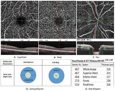 Retinal vascular assessment in psoriatic patients with and without  metabolic syndrome using optical coherence tomography angiography