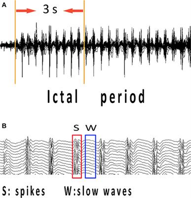 Frontiers Changes Of Ictal Onset Epileptic Network Synchronicity In Childhood Absence Epilepsy A Magnetoencephalography Study Neurology