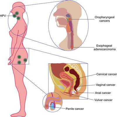 living with mesothelioma cancer