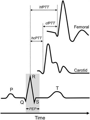 Frontiers | Acute Changes in Carotid-Femoral Pulse-Wave Velocity Are  Tracked by Heart-Femoral Pulse-Wave Velocity
