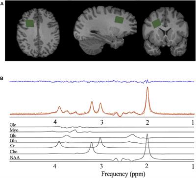 Brain Metabolite Levels in Sedentary Women and Non-contact Athletes Differ From Contact Athletes pic