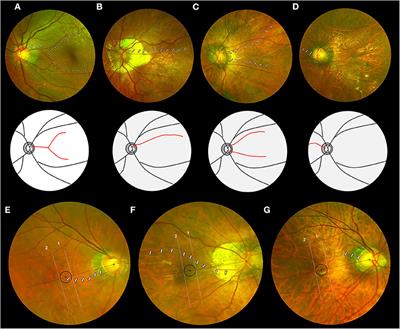myopia complications retina