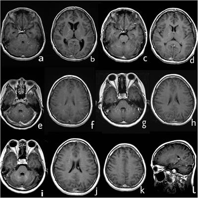 Frontiers | A Case Report of Autoimmune Glial Fibrillary Acidic Protein ...