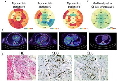 Myocarditis - The Quest For New Approaches In Myocarditis And Inflammatory Cardiomyopathy Sciencedirect / Myocarditis, also known as inflammatory cardiomyopathy, is inflammation of the heart muscle.