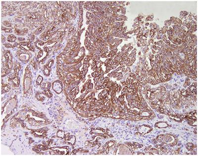 retroperitoneal lymph nodes cancer symptoms