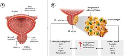 vascularis prosztatitis)