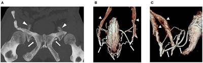 Frontiers | Percutaneous Treatment of Venous Erectile Dysfunction