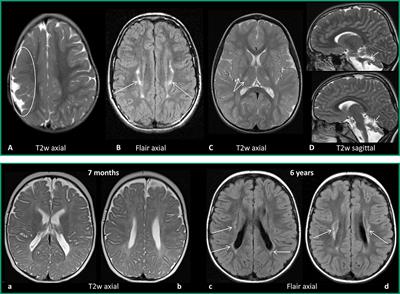 Frontiers | The of Neuroimaging and Genetic Analysis in the of Children With Cerebral Palsy