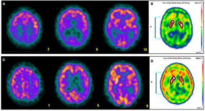 fMRI vs. SPECT Scan for the Brain