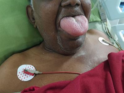 Frontiers | Case Report: Compromised Airway Following Anesthesia and Its  Correlation With the Use of ACE Inhibitors—An Unexpected Clinical Event and  Review of Literature