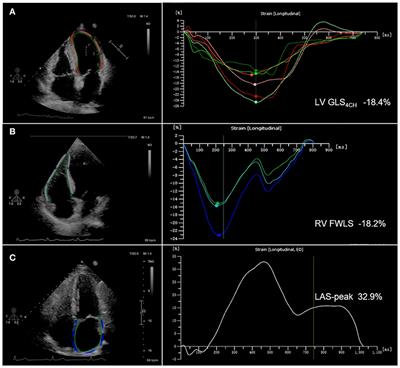 Prognostic Value of Right Ventricular Longitudinal Strain in Patients With  COVID-19