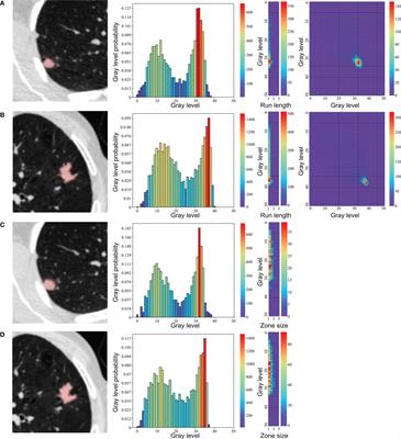 Frontiers | Comparison of Radiomic Models Based on Low-Dose and ...