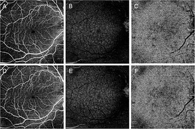 Quantitative Optical Coherence Tomography Angiography Detects Retinal Perfusion Changes In Carotid Artery Stenosis Neuroscience Frontiers Quantitative Optical Coherence Tomography Angiography Detects Retinal Perfusion Changes In Carotid Artery Stenosis Neuroscience Frontiers