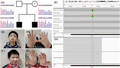 Rubinstein-Taybi Syndrome: A Rare Case Report