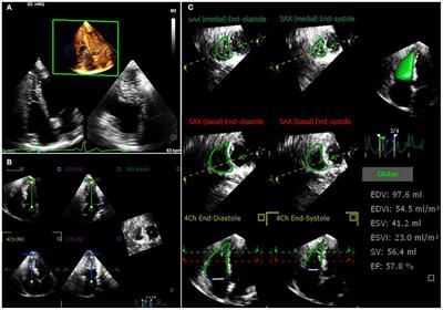 Could strain echocardiography help to assess systolic function in  critically ill COVID-19 patients?