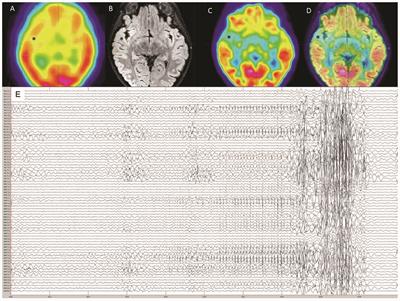 Frontiers Case Report Aperiodic Fluctuations Of Neural Activity In The Ictal Meg Of A Child With Drug Resistant Fronto Temporal Epilepsy Human Neuroscience