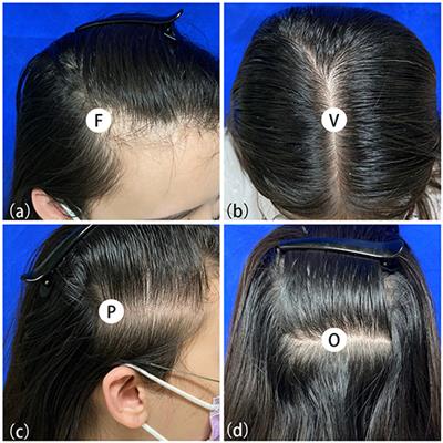 Frontiers | Female Pattern Hair Loss in Female and Male: A Quantitative Trichoscopic Analysis in Chinese Han Patients Frontiers | Female Pattern Hair Loss in Female and Male: A Quantitative Trichoscopic Analysis in Chinese Han Patients
