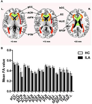 Frontiers Disrupted Structural Brain Connectome Is Related to Cognitive Impairment in Patients With Ischemic Leukoaraiosis image