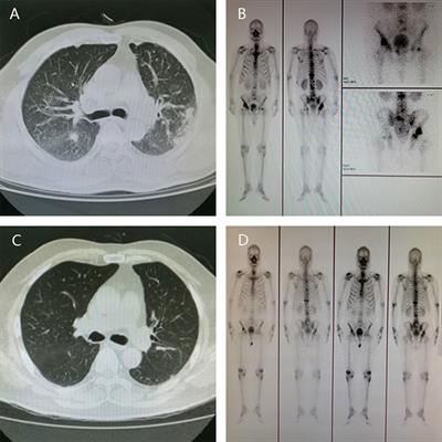 Cancer colon jaunisse, Cancer colon jaunisse, Recherche Sur Le Cancer