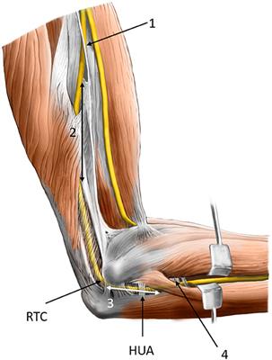 Frontiers  Ulnar Neuropathy at the Elbow: From Ultrasound