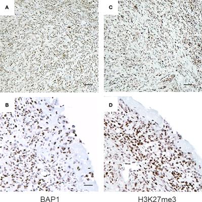Cdkn2a Determines Mesothelioma Cell Fate To Ezh2 Inhibition Oncology Frontiers