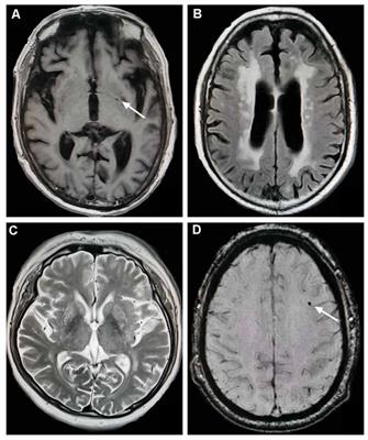 Frontiers | Total Cerebral Small Vessel Score Association With Hoehn ...