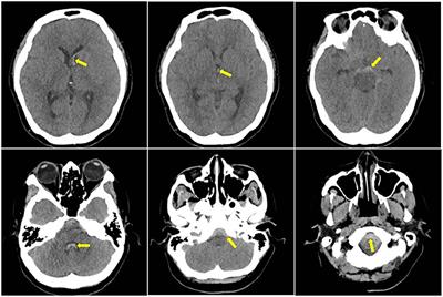 Frontiers | Intracranial Subarachnoid Haemorrhage Caused by Cervical ...
