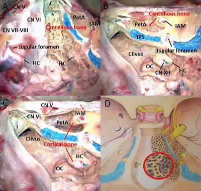 Frontiers | Invasive Corridor of Clivus Extension in Pituitary Adenoma:  Bony Anatomic Consideration, Surgical Outcome and Technical Nuances