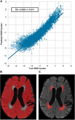 Frontiers Mri Radiomic Signature Of White Matter Hyperintensities Is Associated With Clinical Phenotypes Neuroscience