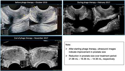 chronic prostatitis treatment 2021