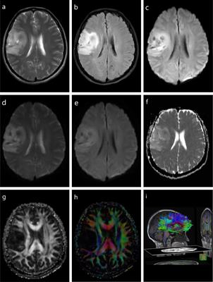 Frontiers | Advanced Diagnosis of Glioma by Using Emerging Magnetic  Resonance Sequences