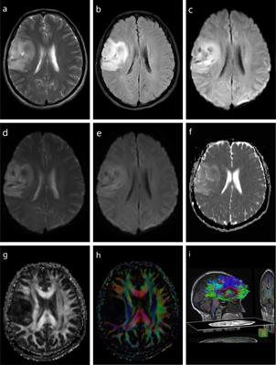 brain scan with tumor