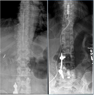 postsynaptic dorsal column spinal cord stimulation