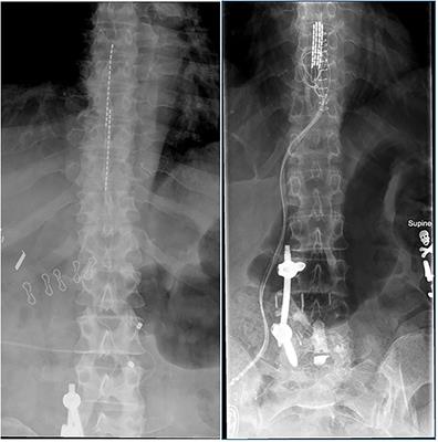 Spinal Cord Stimulation - Pain pacemaker