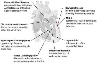 Frontiers | The Immune and Inflammatory of Pediatric Cardiac Disease | Medicine