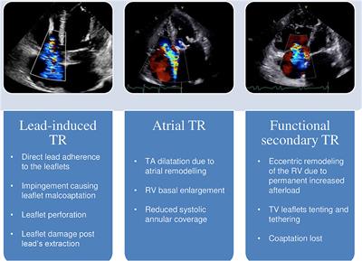 mild mitral aortic and tricuspid regurgitation