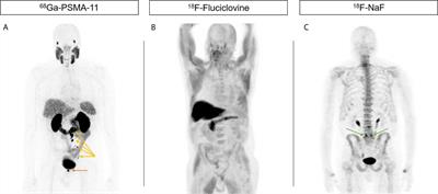 What To Do With a Positive PSMA PET and Negative Conventional Imaging in  Patients With Prostate Cancer