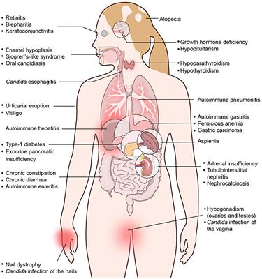 prostatitis és gastritis